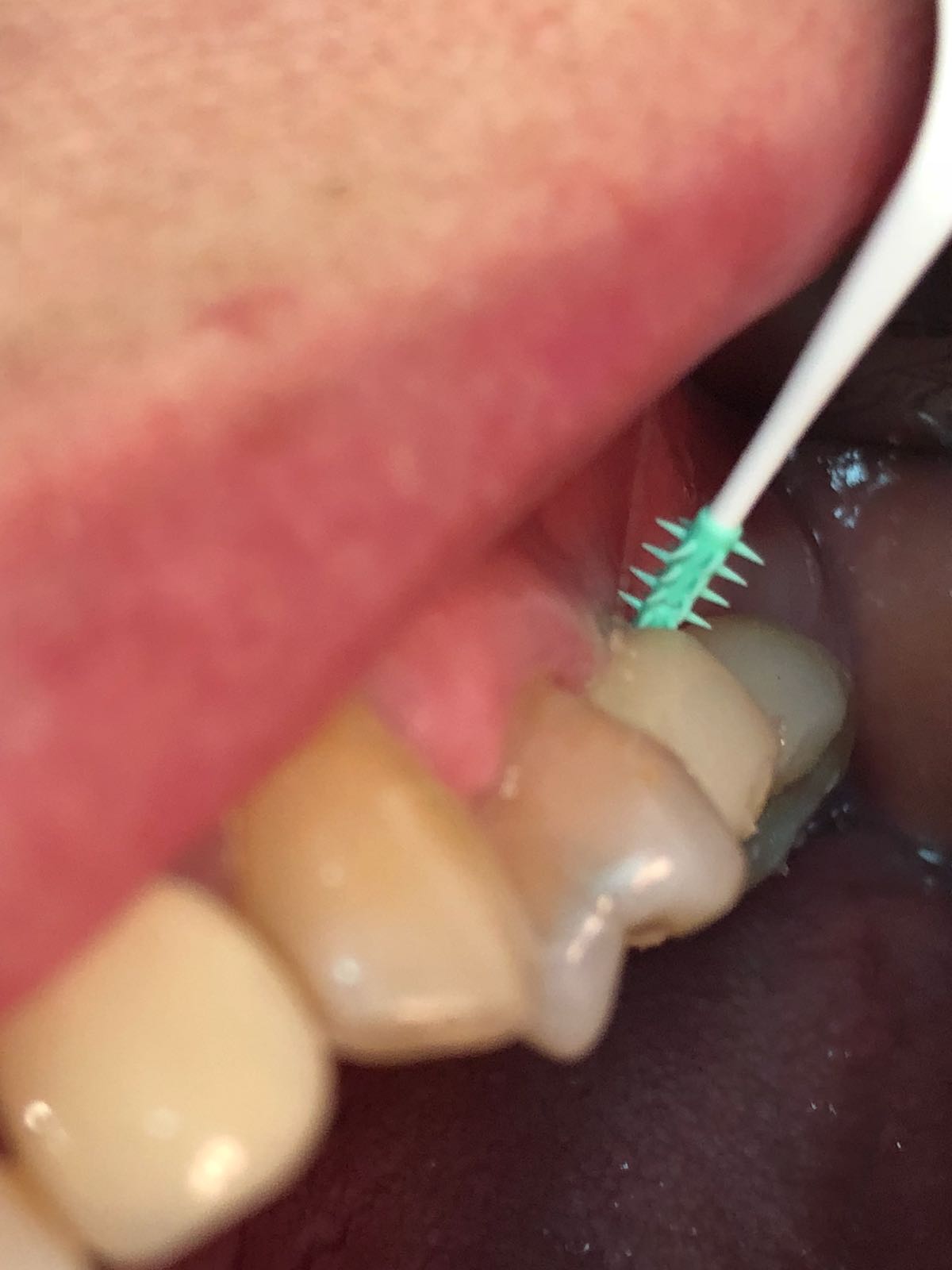 higiene de prótesis dental