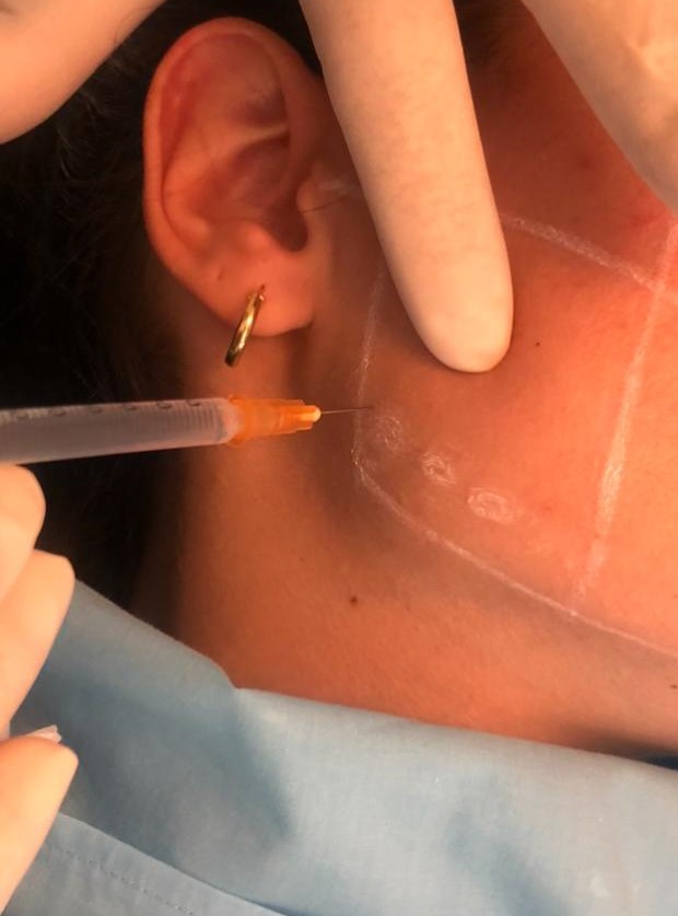 infiltración de botox en músculo masetero