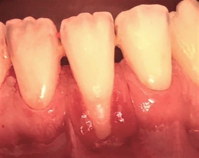 periodoncia antes