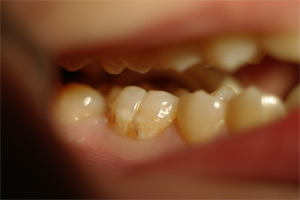 composite1p