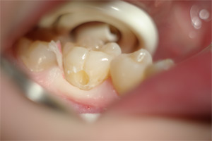 composite2p