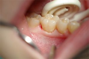 composite3p